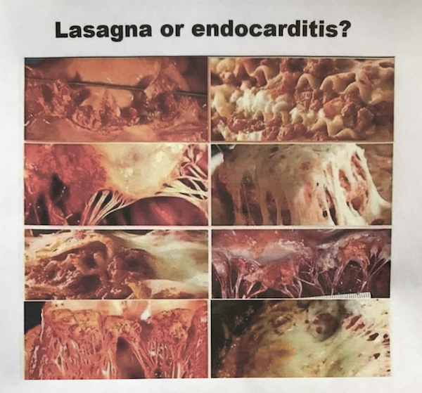 image from Lasagna or Endocarditis?